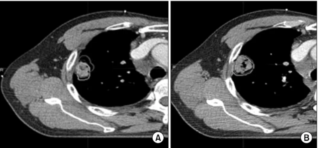 Fig. 10. DVH analyzer v.1 program including normal lung’s normal tissue complication probability (NTCP)