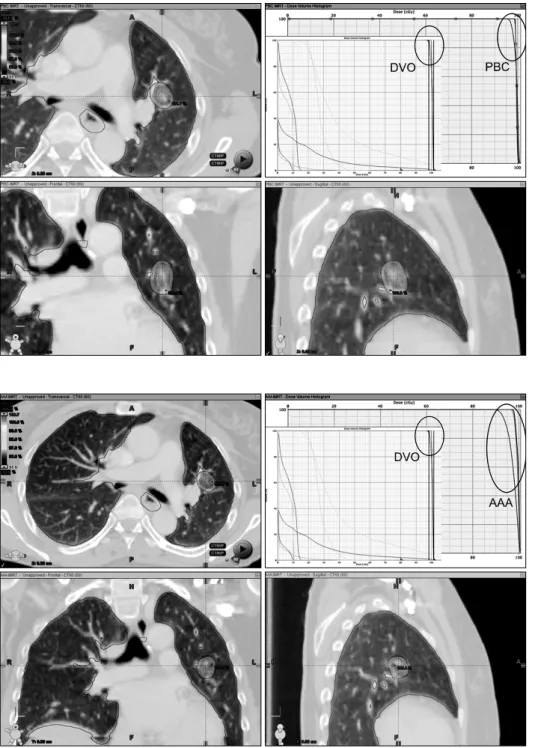 Fig. 7-1. Stereotactic body radio- radio-therapy in lung. Using planning  method is inverse planning and  optimizer is dose volume optimizer  (DVO)