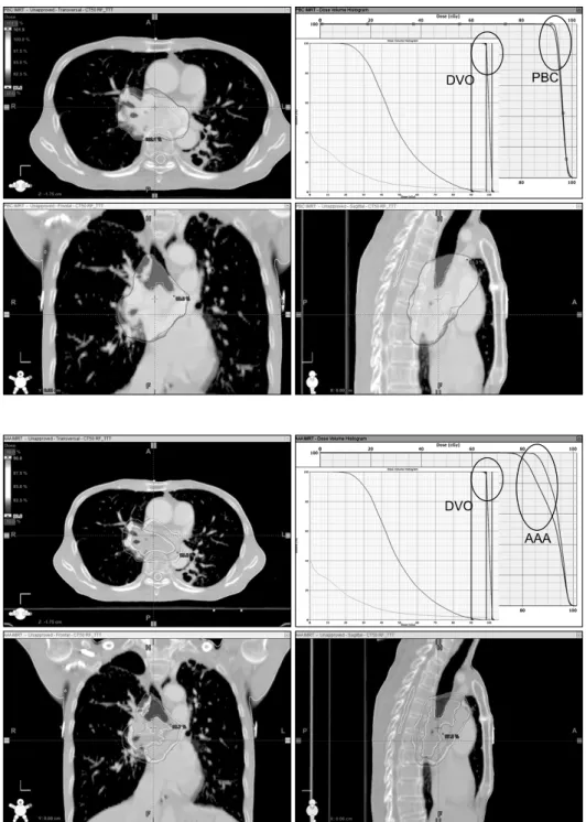 Fig. 8. IMRT planning with large  planning target volume (PTV). 