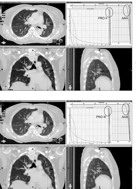 Fig. 9-1. Three rapid arc (VMAT)  planning at lung. Optimization  algo-rithm is progressive resolution  opti-mizer version 10.0.28 (PRO III)