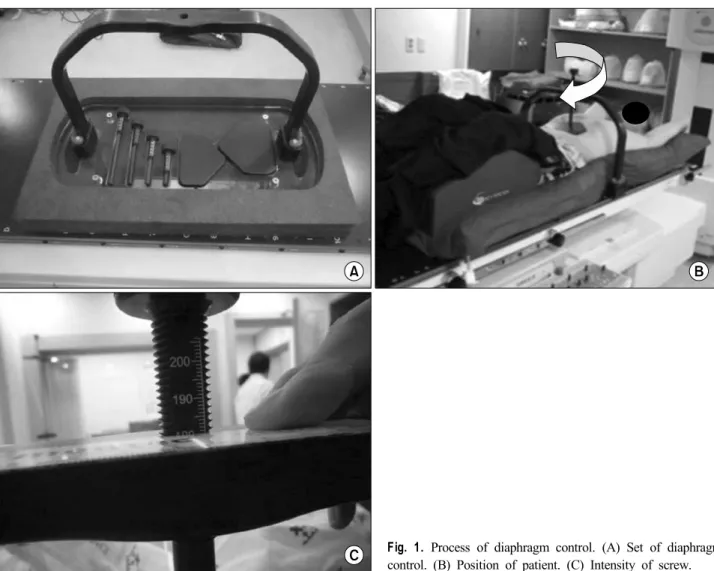 Fig. 1. Process of diaphragm control. (A) Set of diaphragm  control. (B) Position of patient