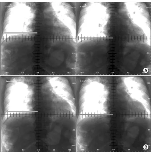 Fig. 2. 2D fluroscopy image with  and without diaphragm control. (A)  Without diaphragm control