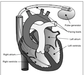 Fig. 1. Structure of a pacemaker (http://www.understandingatrial  fibrillation.com/16)