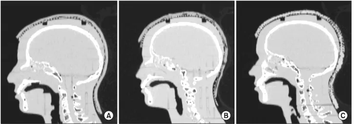 Fig. 3. CT-scan image to the 3 kinds of helmet applicator respectively. Bolx-II (A), paraffin wax (B), thermoplastic materials (C).