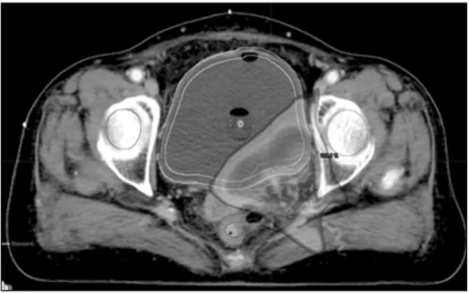 Fig. 4. Without injection of saline volume change of the bladder.
