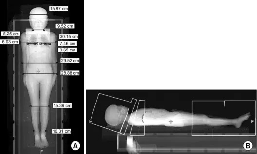 Fig. 2. Setup image for total body irradiation using the extended  SSD technique.료에서 첫 치료 시 측정된 선량값으로 전체 및 각 부위의 선량을 보정하여 다음 치료부터 적용하게 하기 위함이다