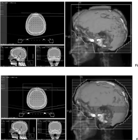 Fig. 4. MLC technique.