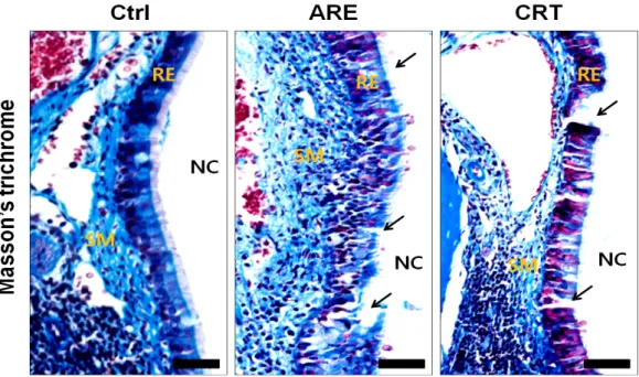 Fig. 3. The repair of AR induced respiratory epithelial damages (arrow) by CRS (Masson trichrome stain)
