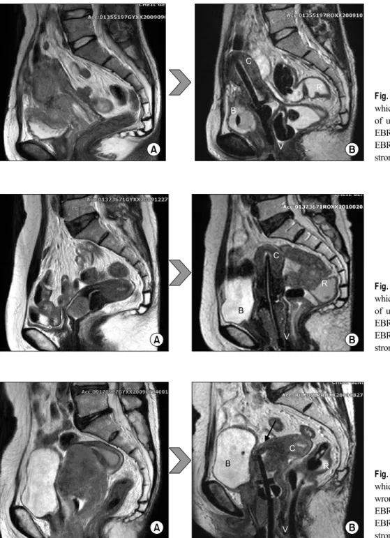 Fig. 3. In case of good insertion  which tandem get into anteflexion  of uterus. (A) MR image of before  EBRT, (B) MR image of after  EBRT