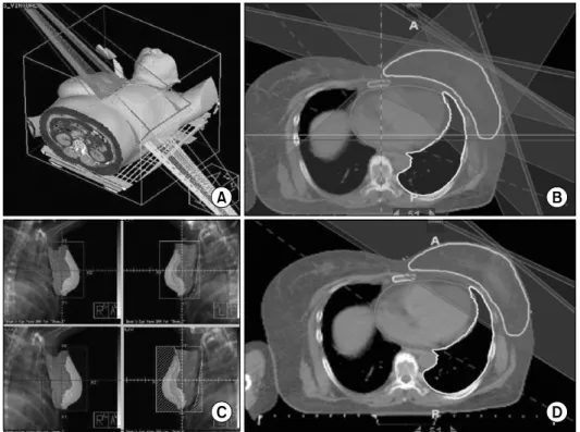 Fig. 1. Treatment plans for left-  sided breast cancer patients. (A)  Wedged tangential fields technique,  (B) Tomo Direct IMRT (5 port),  (C) Field in field technique, (D)  Tomo Direct.