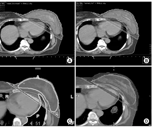 Fig. 2. Dose distributions of treat- treat-ment plans for one representative  patient