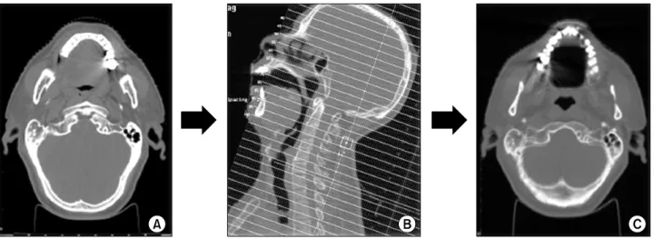 Fig. 3. Process of reconstruction by gantry tilt scan: 20 o  gantry tilt scan (A), multi planar reconstruction (B), reconstruction image (C).