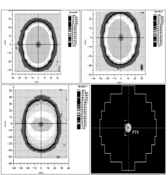 Fig. 10. After the dose conversion from the absorbed spectrum of  Gafchromic EBT films, comparions of isodose distributions among  static, gating, moving patterns were  analyzed.호흡추적장치가 관찰하는 움직임의 정도가 종양의 움직임을 정확하게, 또는 용인 가능한 오차범위 이내에서 예측할 경우 에만 적용 가능하다