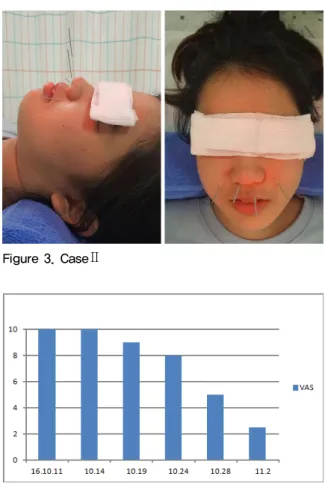 Figure 4. CaseⅡ