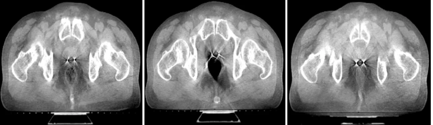 Fig. 1. Observe the rectum volume on CBCT.