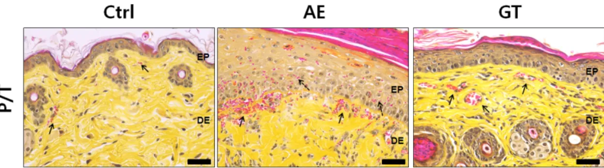 Fig. 3. The alleviation of skin damages by Hataedock. The damage of intercellular space of stratum corneum, hyperplasia,  edema,  infiltration  of  lymphocytes,  and  angiogenesis  (arrow)  were  increased  in  AE,  but  decreased  in  GT  (Phloxine-tartra