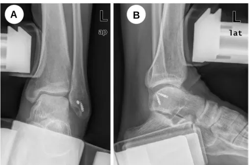 Fig. 5. (A-B) Postoperative stress radiographs show proper placement of double suture anchors in fibula.