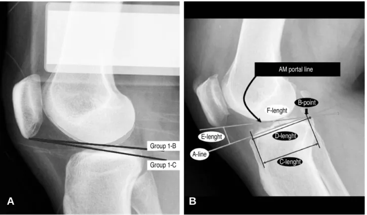 Fig. 1. (A) On 30�flexion valgus stress true lateral plain radiographs, the two kinds of AM portal line were drawn