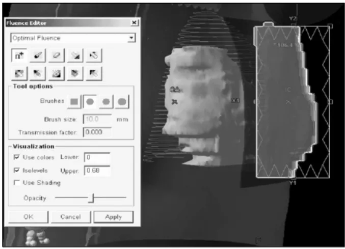 Fig. 1. Irregular Surface Compensator (ISC). Fig. 2. ISC fluence edit.