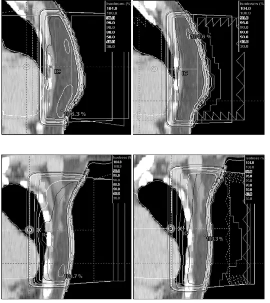 Fig. 7. Wedge filter VS ISC  (coronal 0 cm) 6 MV wedge  45+30 and ISC. 