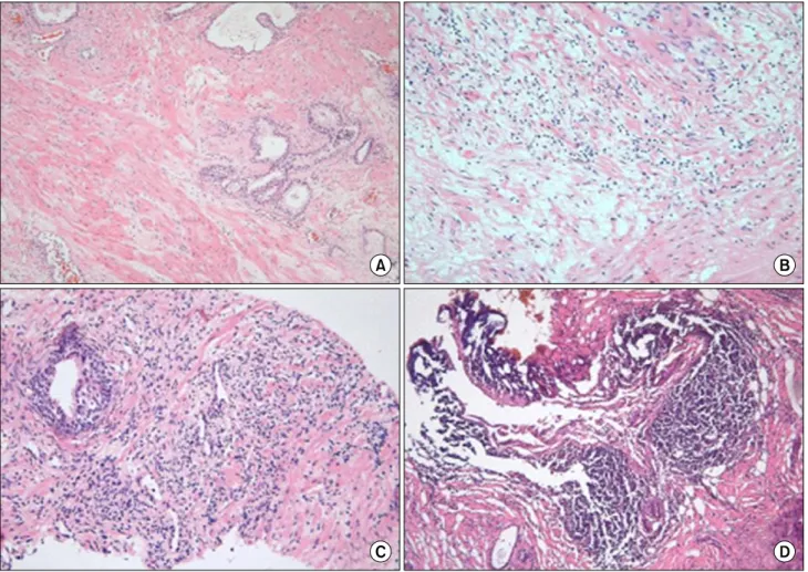 Fig.  1.  Extent  of  chronic  inflammation  in  transurethral  resection  of  the  prostate  (TURP)  specimens  (H&amp;E,  x100)