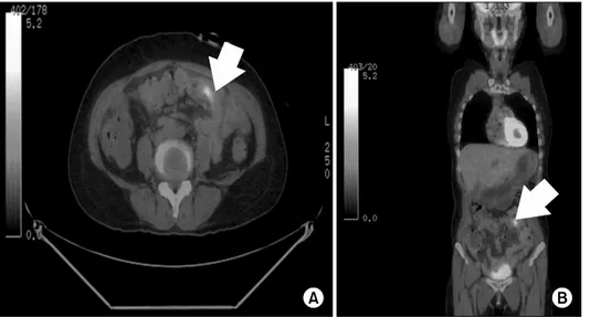 Fig.  3.  [ 18 F]fluorodeoxyglucose-pos- F]fluorodeoxyglucose-pos-itron  emission  tomography  (FDG-  PET)  showing  increased  FDG  uptake  (arrow)  in  the  left  lower  quadrant  of  the  abdomen  in  axial  (A)  and  coronal  (B)  views,  which  sugges