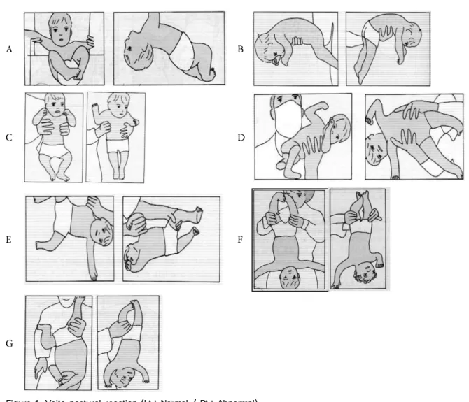 Figure 1. Vojta postural reaction (Lt.: Normal / Rt.: Abnormal) A. Traction reaction 