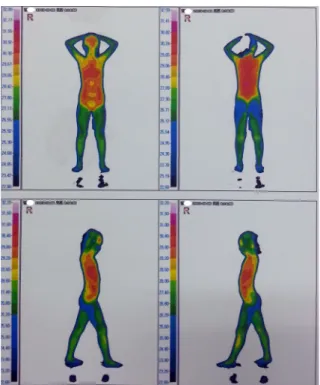 Fig 4. 2013. 10. 5 DITI result 얼굴 등 국소부위에 땀이 나는 것을 말한다 7) .  특히 국 내에서 다한증으로 내원한 환자들 중 수족다한증이 가 장 높은 비율을 차지하고 있고 30세 이하가 대부분이 었으며 6)   어릴 때부터 증상을 느꼈다고 하였다 16) 