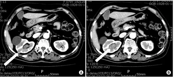 Fig.  1.  Abdominal  CT  scan  showed  a  12  mm  mass  on  the  lateral  aspect,  chromophobe  renal  cell  carcinoma,  and  15x20  mm  mildly  enhancing  mass  (arrow),  urothelial  carcinoma,  on  the  upper  calyx  of  the  right  kidney  (B).