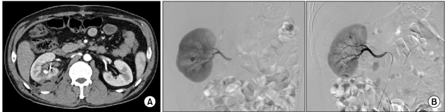 Fig.  1.  (A)  Computed  tomography  with  contrast  in  the  arterial  phase  shows  bright  enhancement  in  the  central  portion  of  the  right  kidney,  suspicious  of  a  pseudoaneurysm
