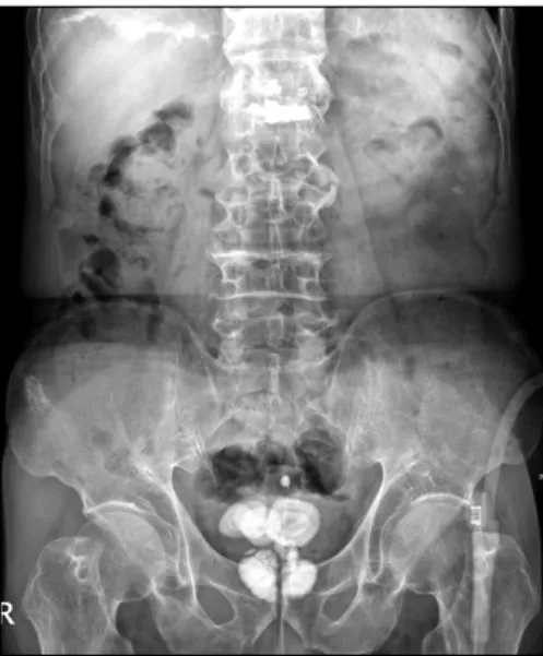 Fig.  1.  KUB  film  showing  multiple  large  calculi  in  the  areas  of  the  bladder  and  prostate.