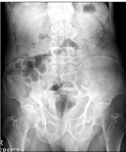 Fig.  2.  Endoscopic  features  of  multiple  prostatic  calculi  in  the  right  and  left  prostatic  fossae.