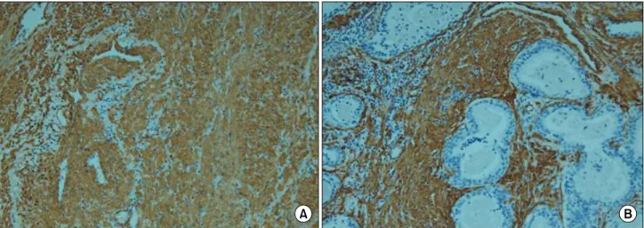 Fig.  1.  High  power  view  shows  (A)  marked  proliferation  of  smooth  muscle  bundles  compared  with  the  small  proportion  of  glandular  components,  and  (B)  dominant  complex  glandular  proliferation  compared  with  the  smooth  muscle  com