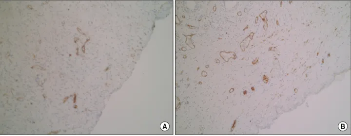 Fig.  1.  Immunohistochemistry  of  CD34-stained  sections  showing  microvessel  density  in  the  finasteride-treated  (A)  and  control  (B)  groups