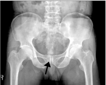 Fig.  1.  Post-implant  AP  pelvis  radiograph  showing  the  distribution  of  the  implanted  seeds  (arrow).