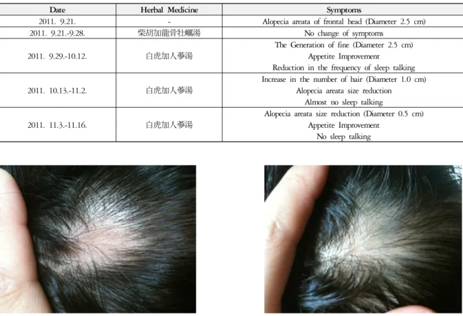 Fig. 1. 2011. 9. 21. Fig. 2. 2011. 11. 16. 하였다. 12. 치료경과 柴胡加龍骨牡蠣湯을 복용한 첫 1주에는 탈모 및 外 症의 변화가 없었고,  白虎加人蔘湯으로 轉方한 후 外 症의 개선 및 탈모의 개선이 관찰되었으며,  총 8주 동 안의 치료 경과는 Table 1에 기술하였다