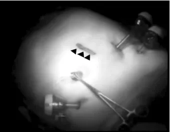 Fig. 1. The  5  cm  mini-laparotomy  wound  for  extracorporeal  urinary  diversion  (black  arrow  head).