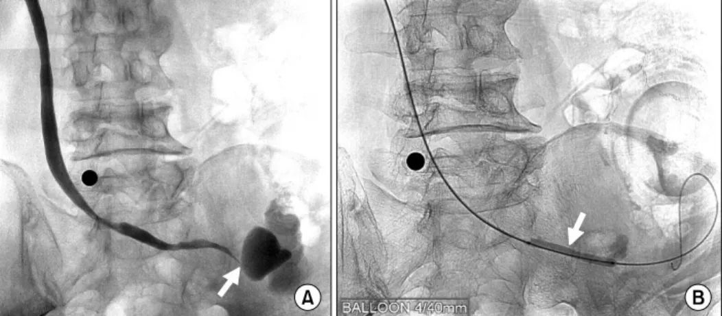 Fig. 4. (A)  Antegrade  pyelography: 