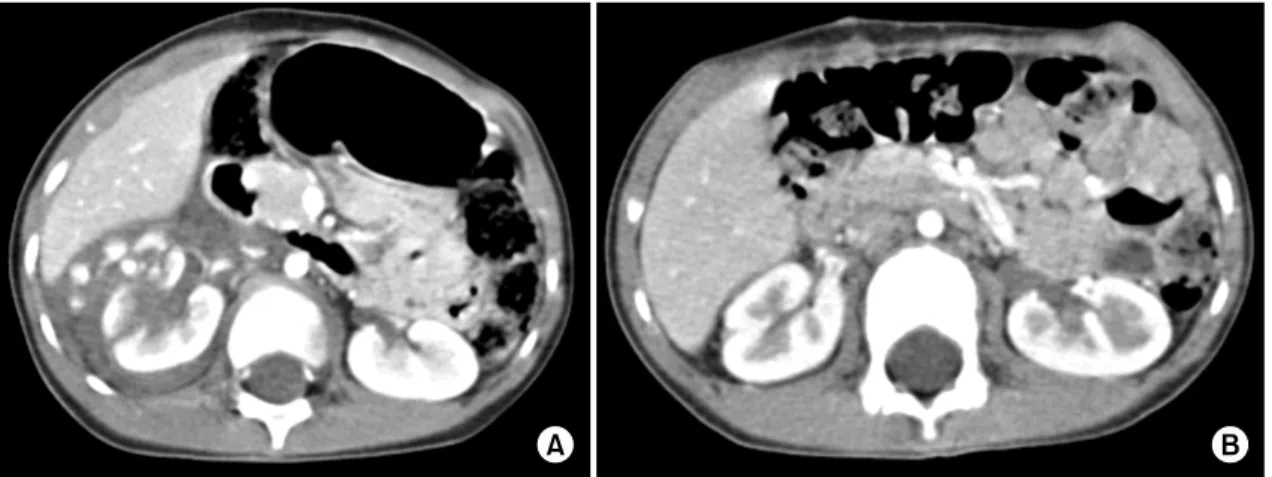 Fig. 2. Eight-year-old  child  with  blunt  renal  trauma.  (A,  B)  On   ad-mission,  computerized  tomography  (CT)  shows  perinephric   extravasa-tion  of  contrast  media  from  left   up-per  collecting  system