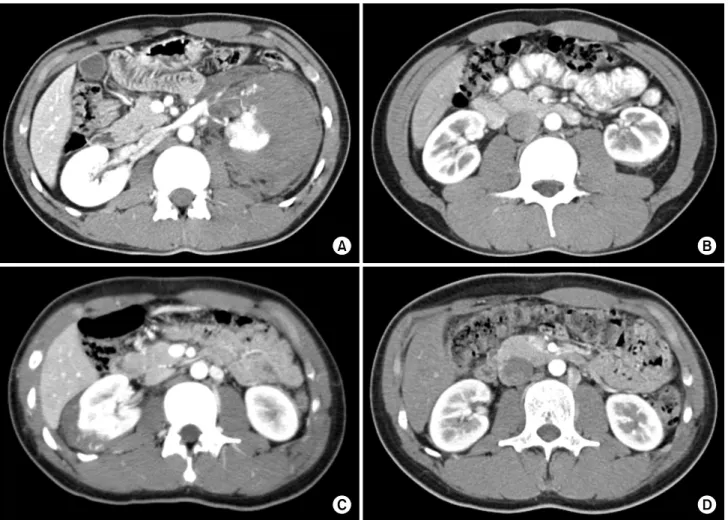 Fig. 3. Computerized  tomography  (CT)  scan  showing  a  grade  V  traumatic  injury  of  left  kidney  each  other