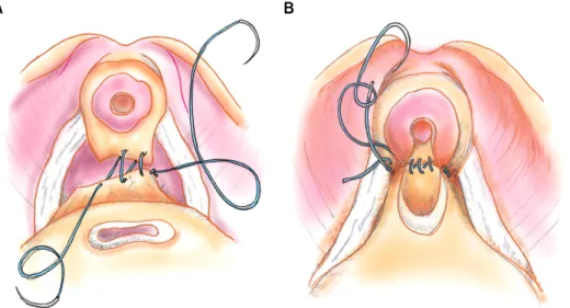 Fig.  1.  Schematic  diagram  of  pos- pos-terior  urethral  reconstruction  during  robot-assisted  radical  prostatectomy