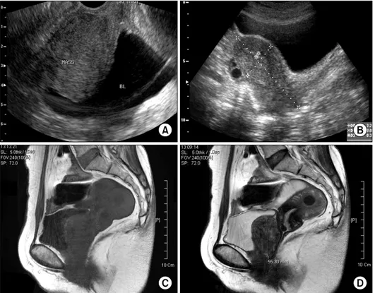 Fig.  1.  (A,  B)  Transvaginal  ultra- ultra-sonography  showing  a  huge  tumor  compressing  the  urinary  bladder