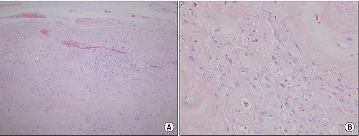 Fig.  3.  Pathologic  findings  show  dispersed  spindle-shaped  cells  and  thick-walled  blood  vessels  with  a  myxoid  stroma  [(A)  x100,  (B)  x400].
