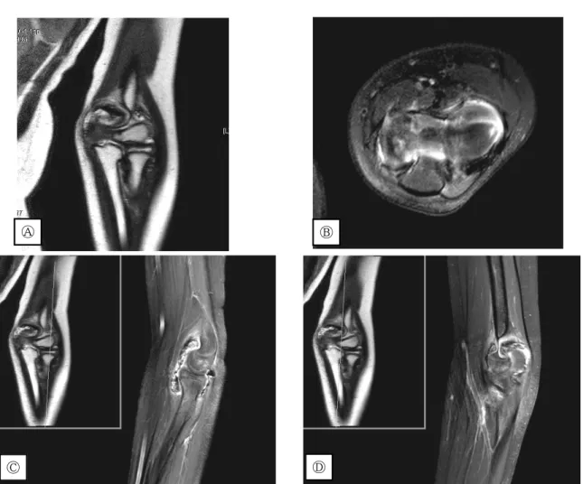 Figure 1. Left elbow MRI(20110522) 