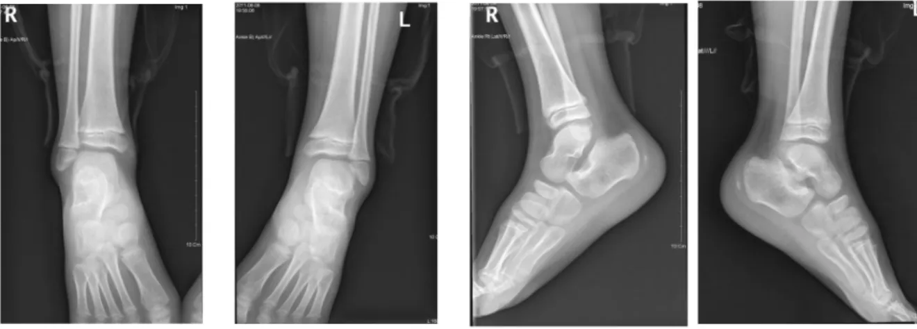 Figure 4. Ankle X-ray(20110608) 