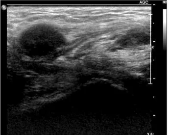 Fig.  1.  Ultrasonography  shows  a  right  inguinal  intracanal  mixed  echoic  structure  with  partial  calcified  nodules.