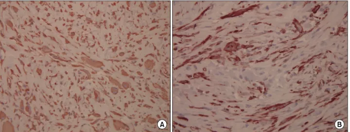 Fig.  4.  The  immunohistochemical  stains  are  diffuse  positive  for  vimentin (A)  and  focal  positive  for  smooth  muscle  actin (B)  in  the  tumor  cells (IHC,  x400)