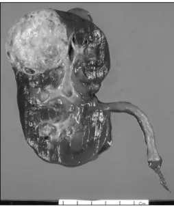 Fig.  2.  Bisected  right  kidney  shows  a  round  well-defined,  pinkish  white,  partly  solid  and  multifocally  cystic  yellowish  rubbery  mass  involving  the  upper  pole  at  the  periphery,  and  the  mass  measured  4.5x4cm