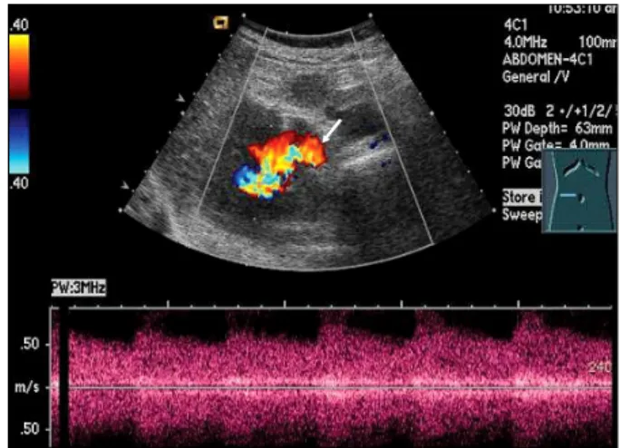 Fig.  1.  Right  renal  color  Doppler  study  shows  arterialization  of  the  renal  vein (white  arrow)