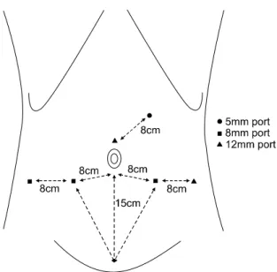 Fig. 1. Port  placement  for  robot-assisted  laparoscopic  radical  prostatectomy (six-port  technique).